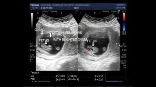 Two sacs one fetus with a Pregnancy of about 9 weeks.