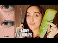 HOW TO REMOVE TINY BUMPS ON YOUR FACE! *They're NOT Acne! | MILIA