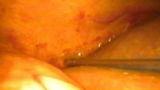 laparoscopic reoperative biliary surgery