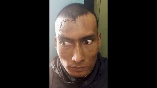 Bulging Scalp After a Head Injury (Tension Pneumocephalus)