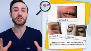 Face the Case- Periorbital Swellings due to Neurotoxin Injections