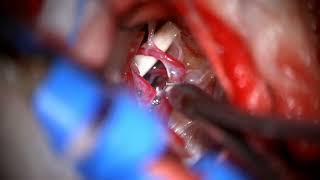 Microvascular Decompression for Trigeminal Neuralgia / Trigeminal Nevraljinin Cerrahi Tedavisi