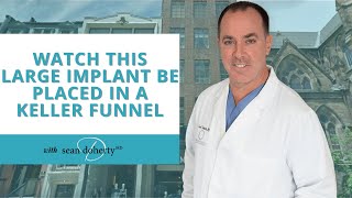 Watch This Large Implant Be Placed In A Keller Funnel!