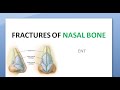 ENT Nasal Bone Fracture Depressed Angulated Treatment Nose Hit middle third face trauma