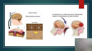 voice over the Child with Alterations in Neurologic function