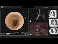 Robotic-Assisted Bronchoscopy to Evaluate a Solitary Peripheral Lung Nodule