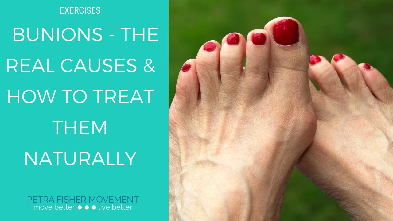 Bunions - The Real Causes & Natural Solutions - YouTube