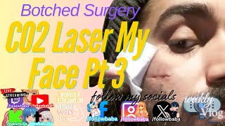 My Botched Cyst Surgery Story: Documenting CO2 Laser Scar Treatment Journey (Part 3)