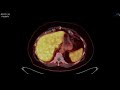 PSMA PET/CT F-18 Pylarify case 4