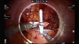 AAGL 2019 Intracorporeal Anastamosis Tutorial