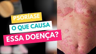 O que é PSORÍASE l Sintomas e características dessa doença inflamatória