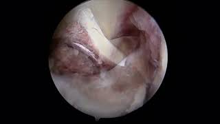 Arthroscopic Assisted Anterior Cruciate Ligament Tibial Spine Avulsion Reduction and Cortical Button