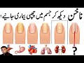 Nails can tell about Hidden diseases (Urdu/Hindi) | Nakhun Dakh kar Jism main chupi bimari jano ?