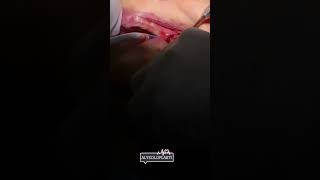 Aynı seansta 3 diş çekimi, Gömülü diş çekimi//Impacted tooth extraction