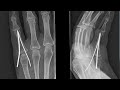 x ray of a pinned finger fracture