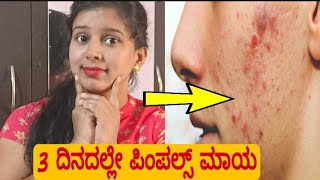 ಮೊಡವೆ ಹಾಗೂ ಮೊಡವೆ ಕಲೆ 3 ದಿನದಲ್ಲೇ ಮಾಯಮಾಡುವ Chemical free  Anti Acne  Gel | Mars by GHC