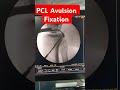 PCL Avulsion Fixation ...Dr Sai Chandra