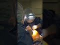 brief demo of custom total knee replacement.