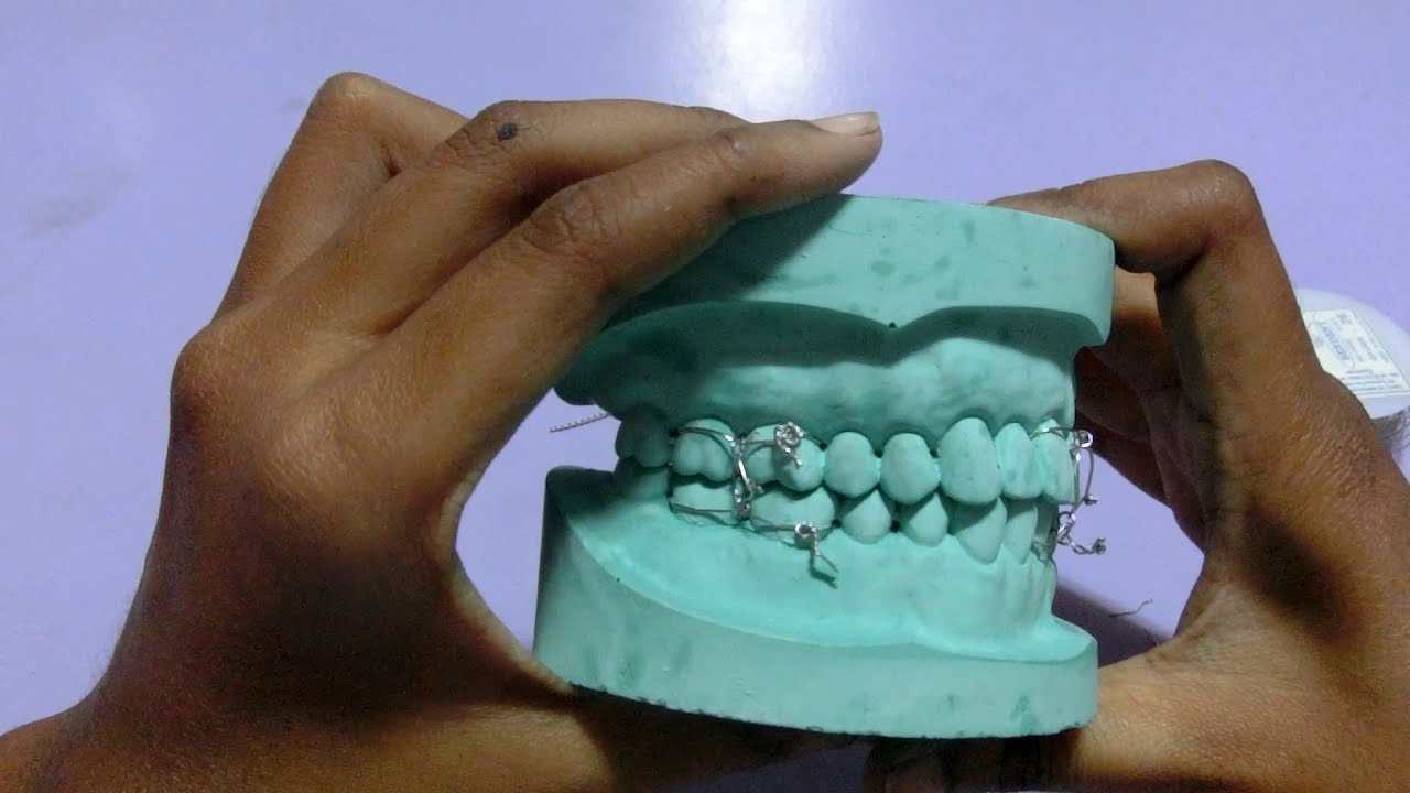 Ivy Loop Eyelet Wiring For Intermaxillary Fixation On Dental Model ...