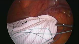 Laparoscopic Repair of a Spigelian Hernia