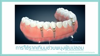 รีวิว เคสทำรากเทียมร่วมกับฟันปลอมที่ YDC Dental