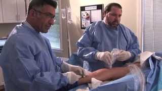 RF Procedure for treatment of varicose veins