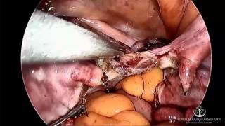 LAPAROSCOPIC BLADDER FLAP HYDRO DISSECTION FROM A MIDLINE UMBILICAL APPROACH  AAGL 2015