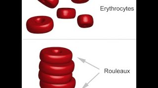 Multiple Myeloma