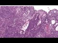 epithelioid angiosarcoma cd34 negative australasian dermpath 2022 case 11 pathology