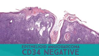 Epithelioid angiosarcoma (CD34 negative!!!) (Australasian Dermpath 2022 - Case 11) pathology