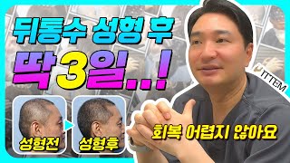 두상성형-뒤통수성형 후 통증, 치료, 회복까지 모두 알려드립니다!