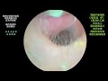 采耳哥 clean the fungal dry patches on the eardrum｜652