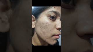 2 month complete tretinoin cream 0.025% #face #tretinoin #skincare #tretinoincream #darkspots #face