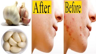 How to Use Tomato with Garlic for PImpal Treatment _ Dark Spots \u0026 Pigmentation Removal