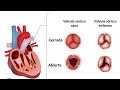 Estenosis AÓRTICA, Válvula Aórtica Enferma  *2 años de Operación a corazón abierto*🫀