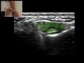 Musculoskeletal Ultrasound: Wrist 3: dorsal transverse scan