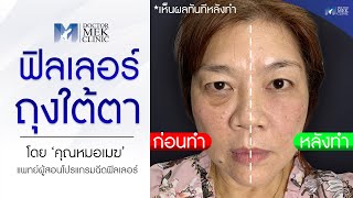 รีวิวจากคนไข้จริง - ฉีดฟิลเลอร์ถุงใต้ตา โดยคุณหมอเมฆ อาจารย์แพทย์ผู้สอนฉีดฟิลเลอร์