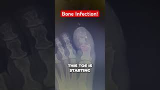 Progression of Bone Infection #osteomyelitis #podiatry