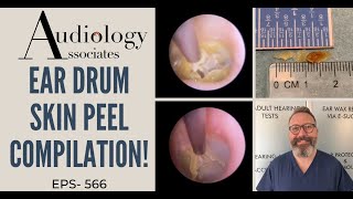 EPIC EARDRUM SKIN PEEL COMPILATION - EP566