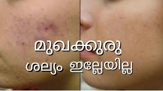 മുഖക്കുരു ഇനി ഇല്ല | get rid of pimples | മുഖക്കുരുവും പാടുകൾ മുഴുവനും മാറ്റാം | 100 % Result |