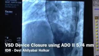 DrRaviRT- perimembranous VSD device closure using ADO II device