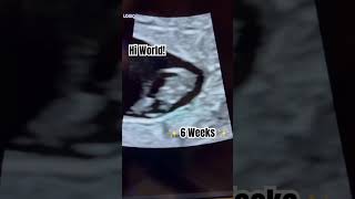 6 weeks pregnant scan #ultrasound