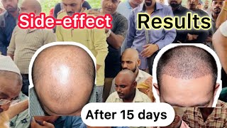 Result ओर side-effects ll mr . Salman hair treatment 👴🏾