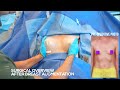 Late 30 Year Old, Silicone Breast Augmentation, Dr. William Rahal, Beverly Hills, CA