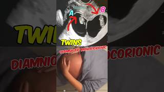 Double joy, Twins ultrasound | Diamniotic Monochorionic | Girls  #pregnancy #baby#shorts