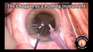 Use the chopper to push nuclear pieces to the phaco tip during cataract surgery