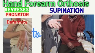 Hand Forearm Orthosis || Supinator Support Brace - for Correcting Pronator Deformity to Supination