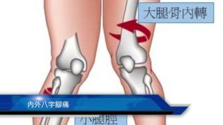 2017年矯形科技: 矯正扁平足 八字腳