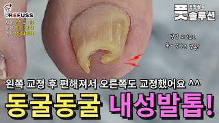 아팠던 왼쪽발톱 교정후 대만족하신 어르신! 한달후 우측교정하며 영상 남겨주셨어요^^ #조원장의풋솔루션 #레푸스상도점 #레푸스동탄역점 #레푸스성남태평점 #레푸스 #내성발톱