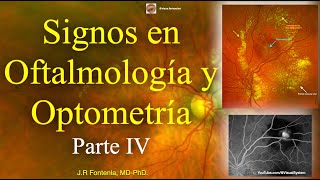 Clase de Signos en Oftalmología y Optometría, Parte IV.